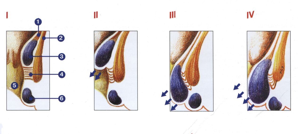 hemoroīda attīstības stadijas