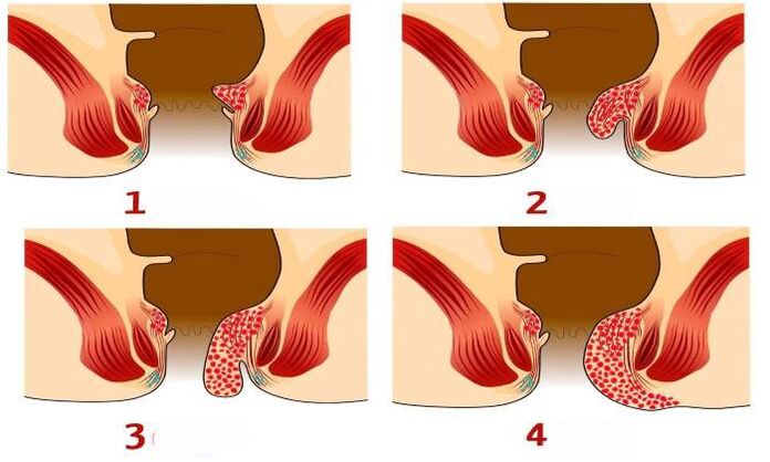 kā hemoroīdi izskatās dažādos posmos